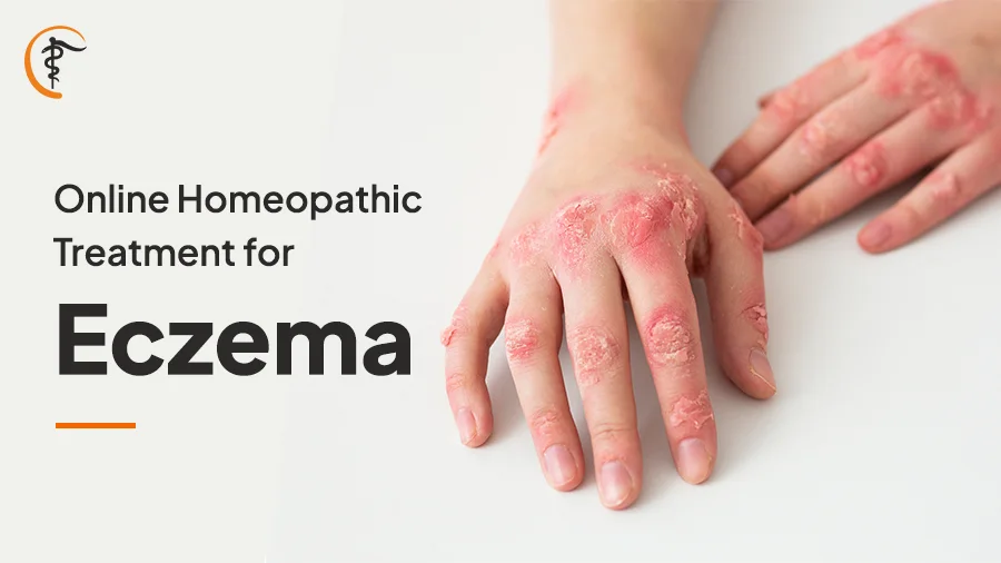 Online Homeopathic Treatment for Eczema - Satyam Homeopathy