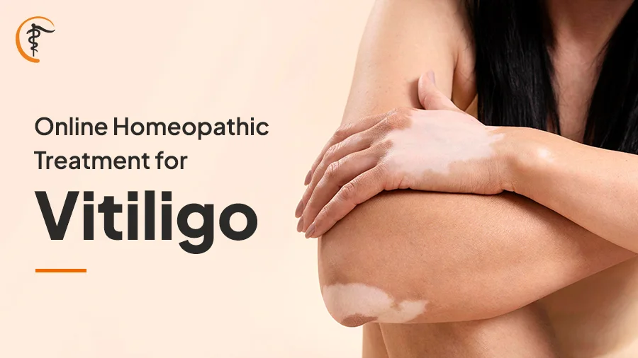 Online Homeopathic Treatment for Vitiligo - Satyam Homeopathy